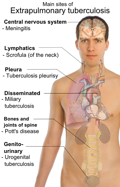 Extrapulmonary_tuberculosis_symptoms