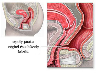 fistula_msolata