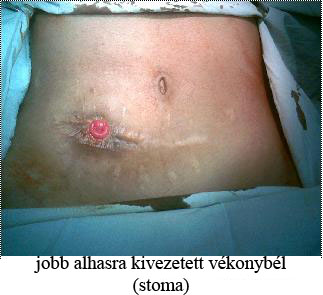 stoma_msolata
