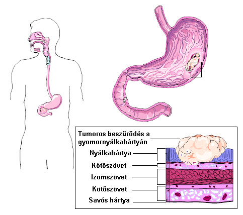 gyomorrak