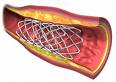 stent